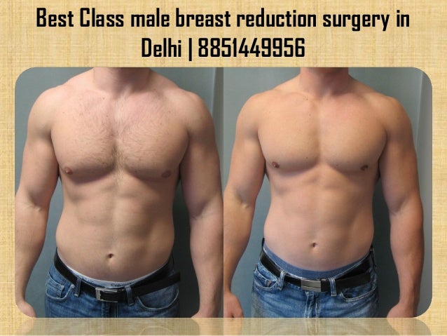 male breast reductions Male breast reductions